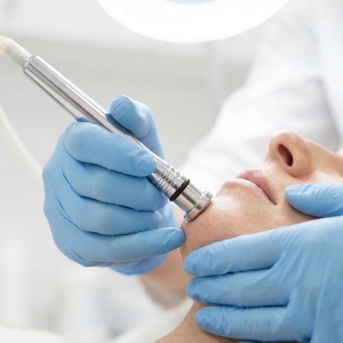 Limpieza.facial.profundo.con.punta.de.diamante