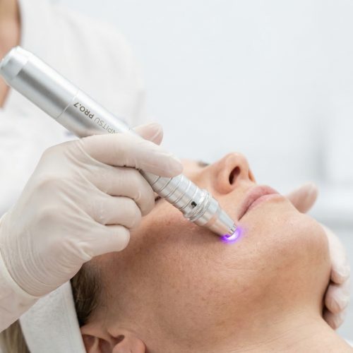 dermapen facial endor