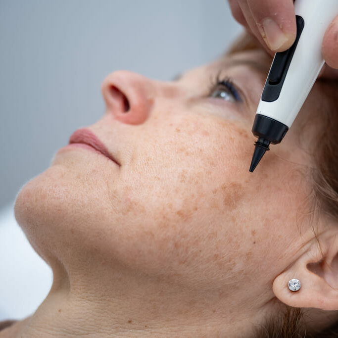 Tratamientos Faciales