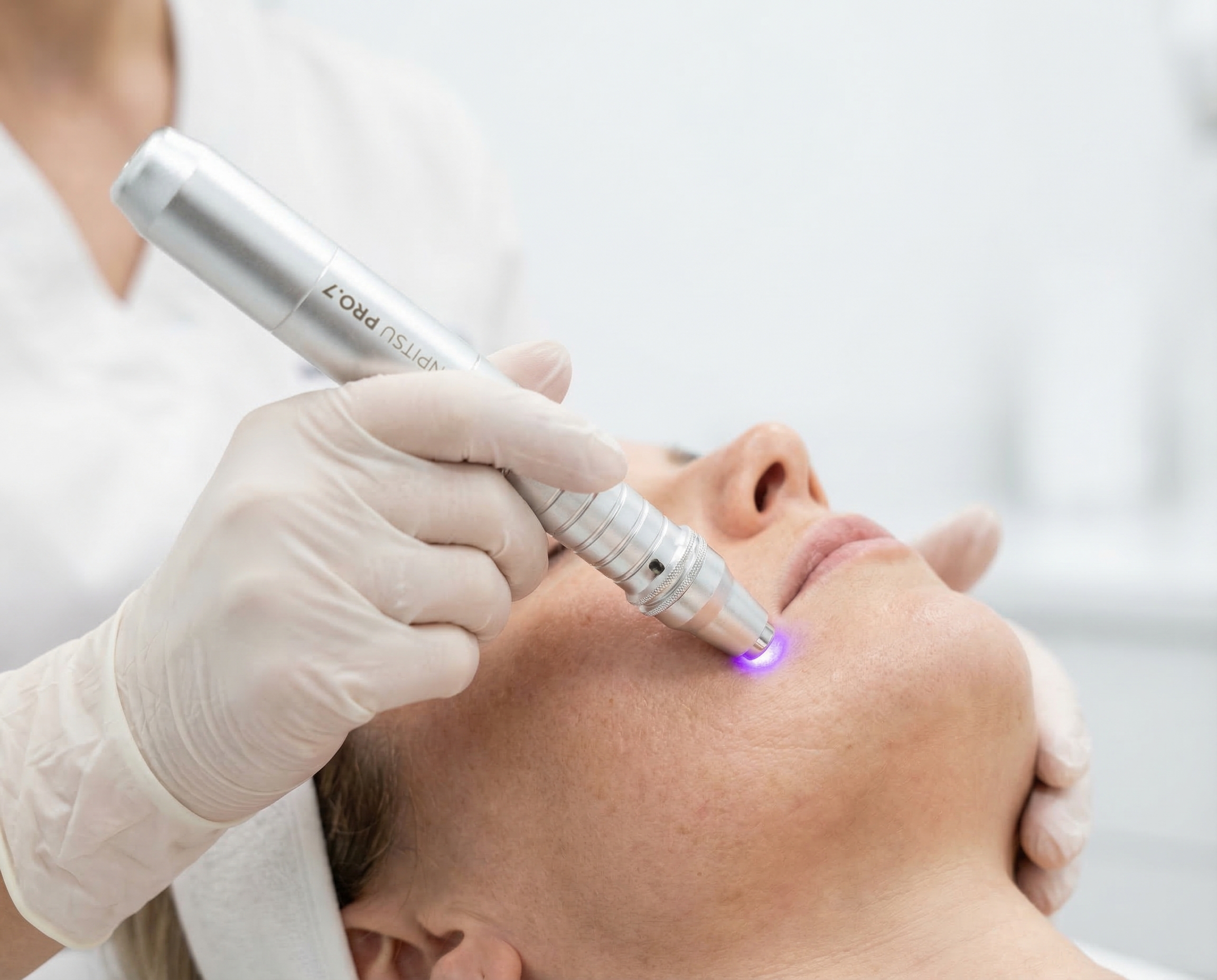 dermapen facial endor